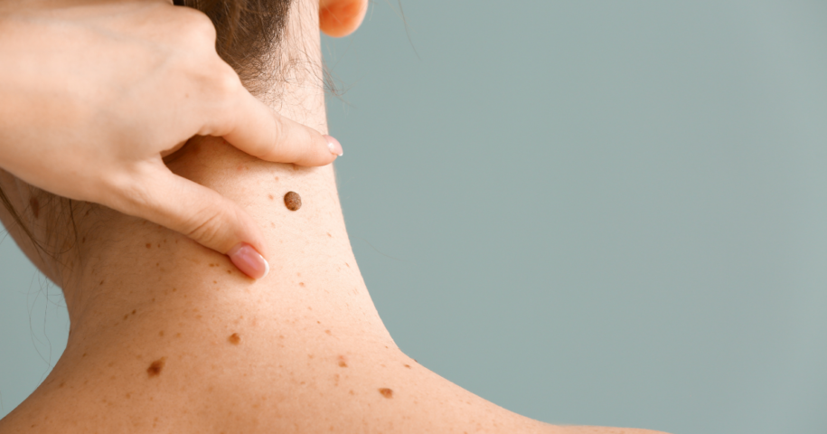 laser mole removal Reston
