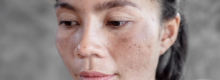 Melasma Treatments in Reston VA