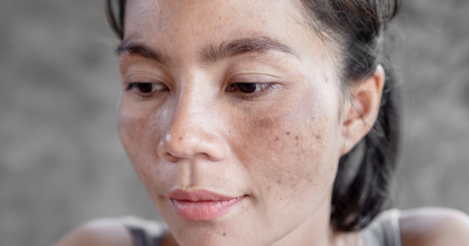 Melasma Treatments in Reston VA