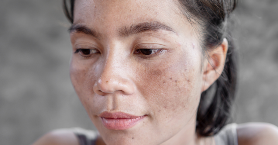 Melasma Treatments in Reston VA