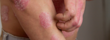 psoriasis treatment reston