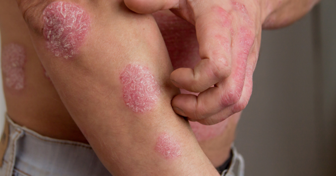 psoriasis treatment reston