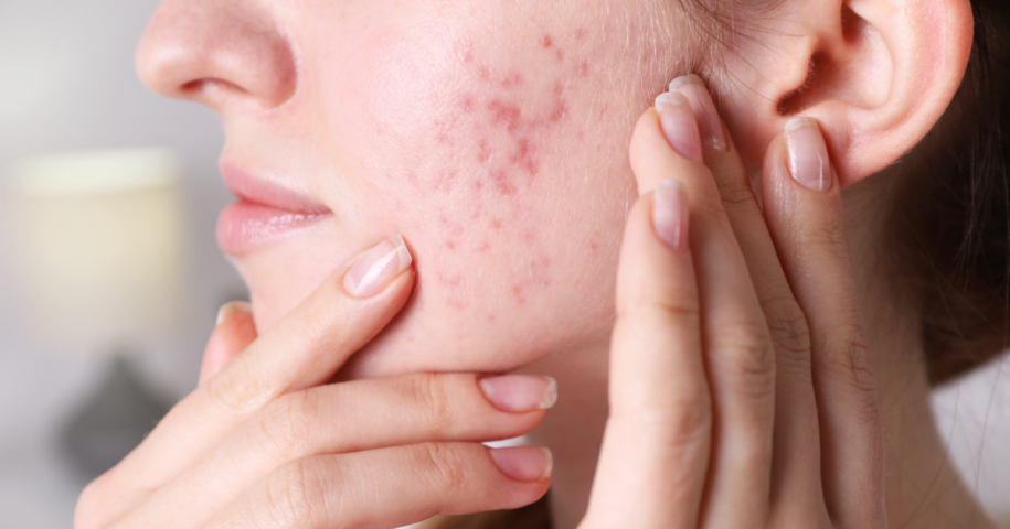 dermal fillers for acne scars