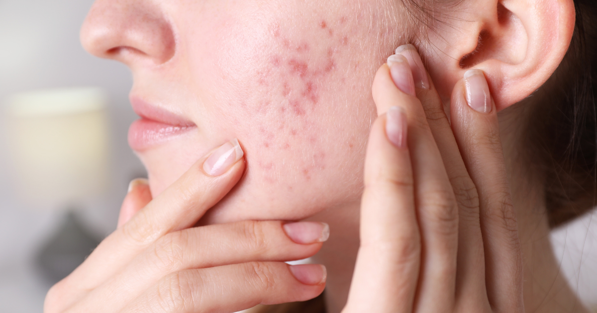 Smooth Acne Scars with Dermal Fillers