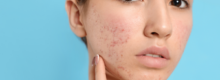 biostimulators for acne scars