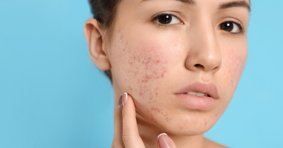 biostimulators for acne scars