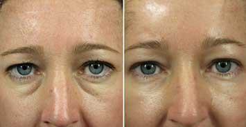 Under Eyes