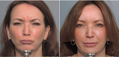 Before After