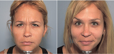 Before and After