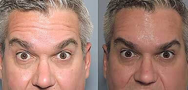 Before and After