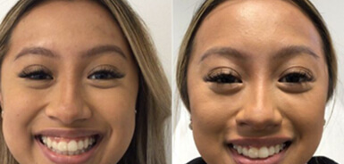 Before and After