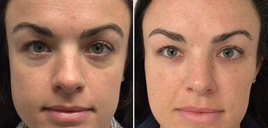 Before and After
