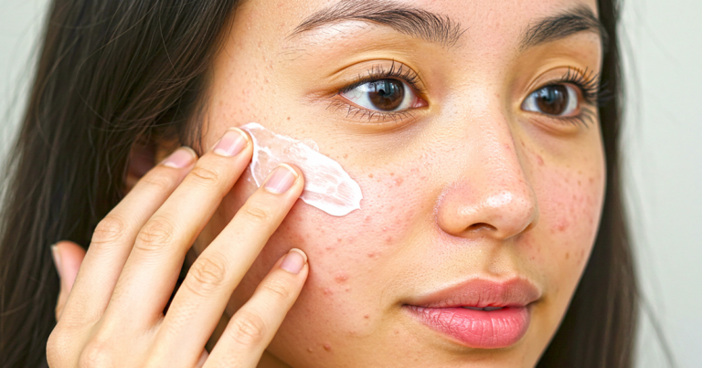 Cabtreo acne treatment