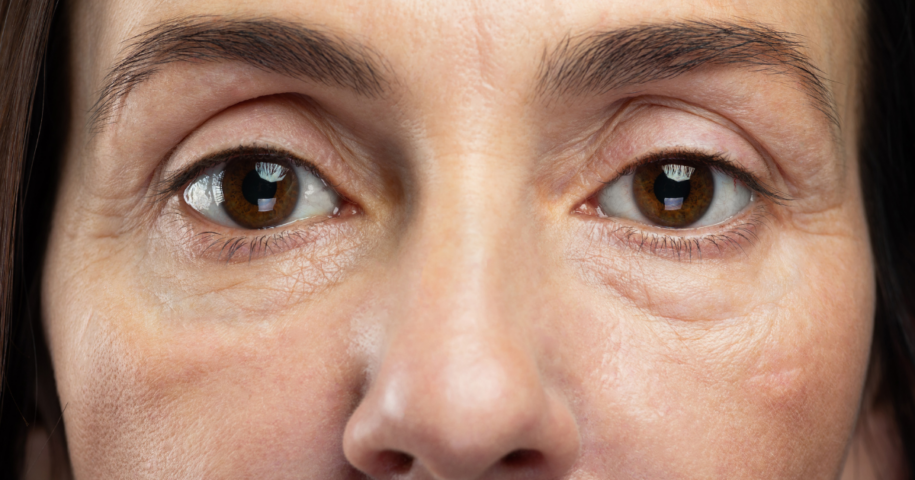 Best Eye Bag Treatments Near Me