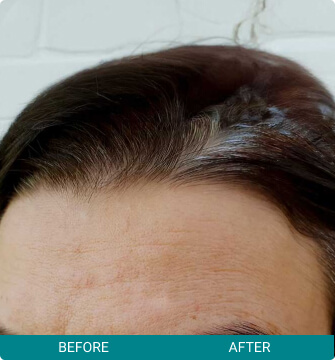 before-after-botox-other-1-a