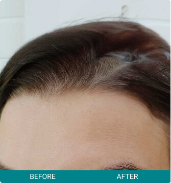 Botox + Other Neuromodulators