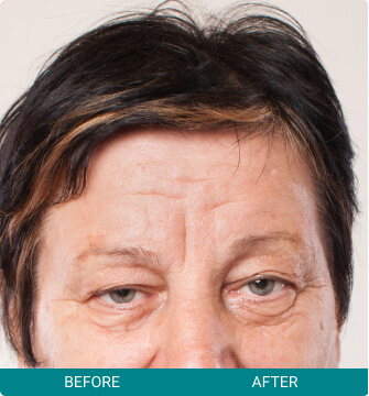 Botox + Other Neuromodulators