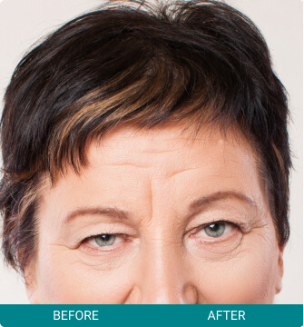Botox + Other Neuromodulators