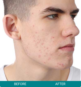 before-after-elective-dermatology-2-a