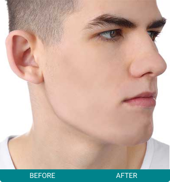 Before After