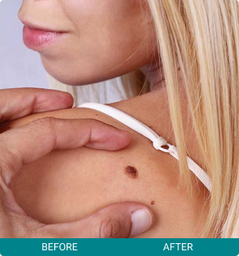 before-after-elective-dermatology-3-a