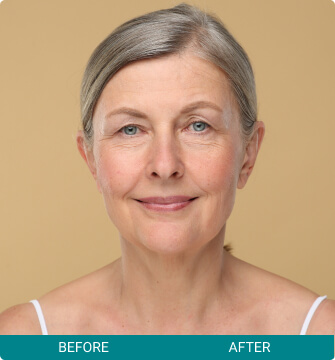 before-after-facial-harmony-1-a Facial Harmony