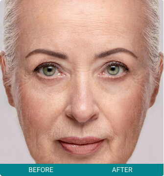 before-after-facial-harmony-2-a Facial Harmony