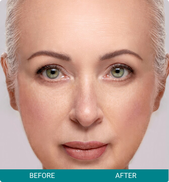 before-after-facial-harmony-2-b