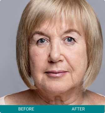 before-after-facial-harmony-3-a before-after-facial-harmony-3-a