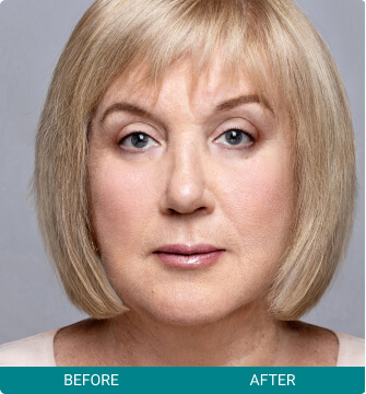 before-after-facial-harmony-3-b