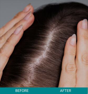 before-after-hair-scalp-1-a Hair Scalp