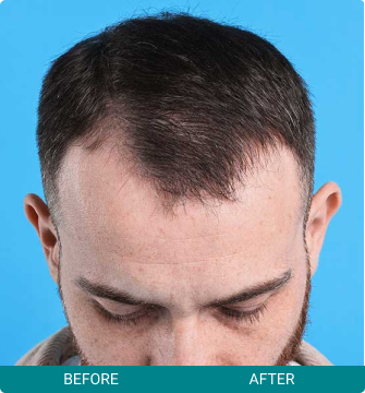 before-after-hair-scalp-1-a Before and After