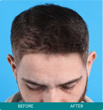 Before and After