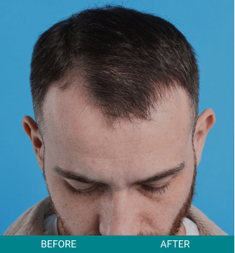 before-after-hair-scalp-2-a before-after-hair-scalp-2-a