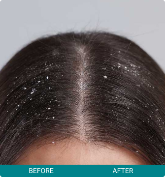 before-after-hair-scalp-2-a Before and After