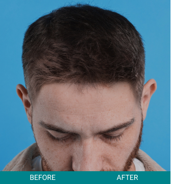 Hair Scalp
