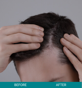 before-after-hair-scalp-3-a Hair Scalp