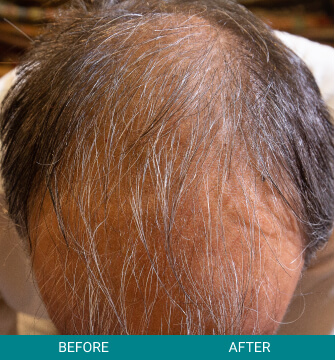 before-after-hair-scalp-3-a Before and After