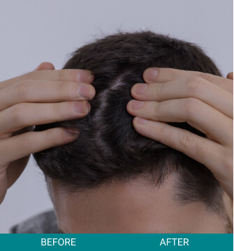 before-after-hair-scalp-3-b