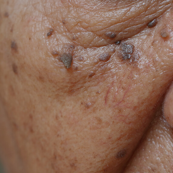 Elective Dermatology