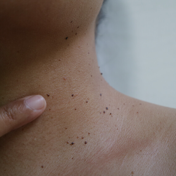 Elective Dermatology