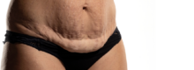 Microneedling for Stretch Marks in Northern Virginia