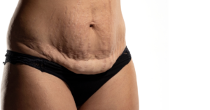 Microneedling for Stretch Marks in Northern Virginia