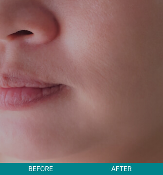 before-after-hydrafacial-md-peels-1-b