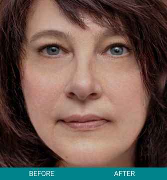 Before and After