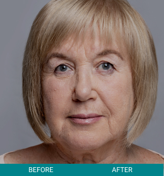 before-after-rejuvanate-tightening-2-a