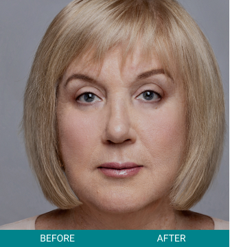 Before and After