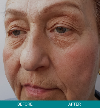 before-after-rejuvanate-tightening-3-a