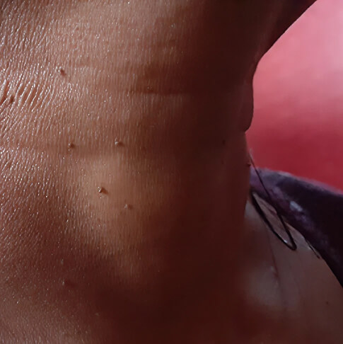 Skin Tags
