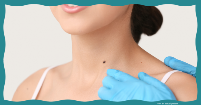 suspicious moles ashburn